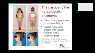 Turner syndrome Beyond the classic XO phenotype [upl. by Zilada]