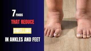 How to AVOID Swollen Ankles and Feet [upl. by Lelith481]