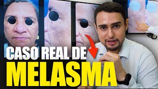 TRATAMENTO PARA MELASMA CASO REAL [upl. by Madian]