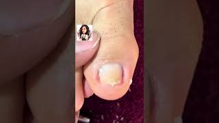 Satisfying Toe Cleaning  Relaxing Foot Care amp Deep Clean ASMR 82 [upl. by Aitan]