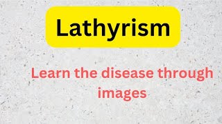 Lathyrism  Learn through images for doctorsnurseshealth professionals [upl. by Ojillek]