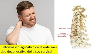 Síntomas y diagnóstico de la enfermedad degenerativa del disco cervical [upl. by Dodie340]