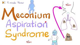 Meconium Aspiration Syndrome MAS  5Minute Review [upl. by Templas]