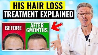 MUST SEE HAIR LOSS TURNAROUND IN JUST 6 MONTHS HOW MENS HAIR LOSS TREATMENT EXPLAINED [upl. by Ugo]