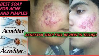 BEST SOAP FOR ACNE AND PIMPLES AND TO REMOVE DIRT FROM ON FACE [upl. by Aspa]