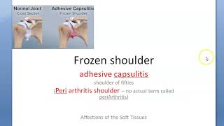 Orthopedics 323 Frozen Shoulder Arthritis adhesive capsulitis shoulder [upl. by Aylsworth791]