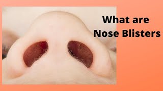 What are Nose Blisters [upl. by Llenyaj]