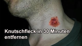 Knutschflecken mit Mundwasser in 30 Min entfernen  Knutschfleck schnell wegbekommen  Tutorial [upl. by Lenad910]