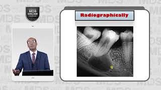 4 3 Radicular Cyst Rediographically [upl. by Ramat]