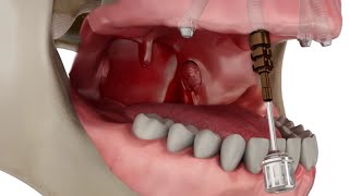 Straumann Pro Arch Step by Step Overview [upl. by Kermie920]