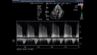 aortic regurgitation [upl. by Amye]