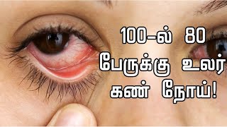 Dry Eyes Home Remedy in Tamil  Dry Eyes Treatment in Tamil  Dry Eyes Symptoms in Tamil [upl. by Rimhsak]