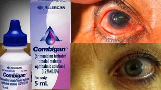 Combigan Eye Drop For Ocular Hypertension glaucoma  Brimonidine  Timolo [upl. by Enirolf]