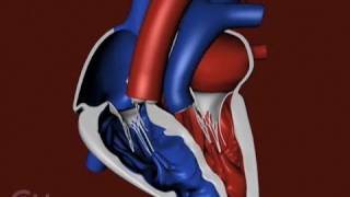 The Structure of a Heart with Transposition of the Great Arteries TGA  CHOP [upl. by Nora944]