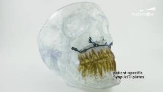 PatientSpecific CranioMaxillofacial CMF Implants  Materialise SynpliciTi [upl. by Aeirdna]