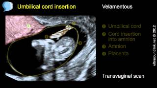 Velamentous insertion of the umbilical cord [upl. by Carlie211]