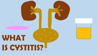 What is Cystitis [upl. by Releehw]