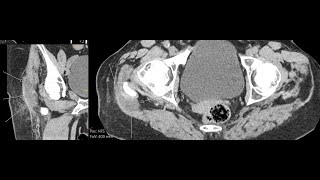 Trochanteric bursitis  CT findings [upl. by Blase]