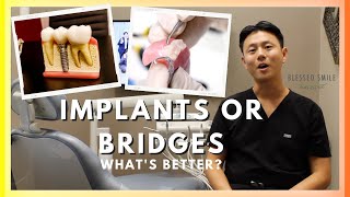 DENTAL IMPLANT vs BRIDGE to replace missing teeth  Dentist Reviews [upl. by Lytsirk541]