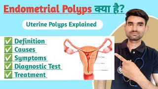 Endometrial Polyp in Hindi  Causes Symptoms And Treatment of Endometrial Polyp [upl. by Etheline]