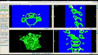 3D vertebrae model creation process using itkSNAP [upl. by Dlaner336]