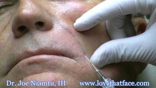 Nasolabial Fold Filler with Cannula by Dr Joe Niamtu [upl. by Yuht958]