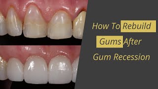 Gum Recession Cure  How to Rebuild Gums [upl. by Eselahc20]