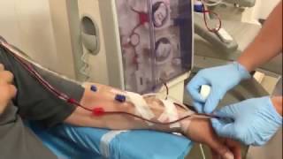 Dialysis connection of a patient with an arteriovenous fistula [upl. by Dolhenty]