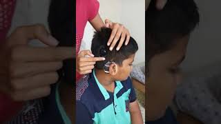 Introduction of cochlear implants [upl. by Oswell]