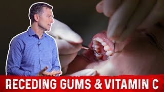 Receding Gums and Vitamin C Explained By DrBerg [upl. by Atiluap239]