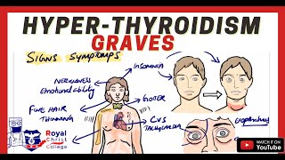 HyperthyroidismThyrotoxicosis and Graves Disease  Causes Pathology Signs amp Symptoms [upl. by Arrik]