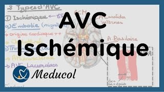 AVC ischémique causes embolie cérébrale AVC thrombose et AVC jonctionnel [upl. by Dysart]