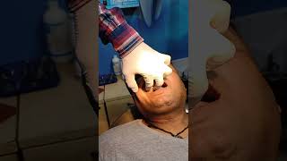 THE UPPER SECOND PREMOLAR TOOTH EXTRACTION [upl. by Lovell59]