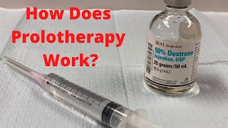 How Does Prolotherapy Work Prolotherapy Explained [upl. by Bensen29]