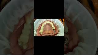 Post 2 yrs  pterygoid implant tapping video [upl. by Tnemelc]