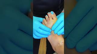 Dislocated toe fracture toe was relocated in the office [upl. by Alikam157]