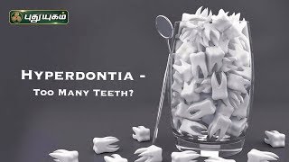 What Is Hyperdontia Treatment and Causes  Dental care  Health Advice [upl. by Decrem537]