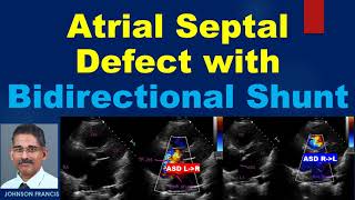 Atrial Septal Defect with Bidirectional Shunt [upl. by Nalorac]