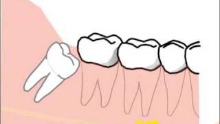 alte Version Erklärung spezieller Probleme und Risiken bei der Weisheitszahnentfernung [upl. by Anihs]