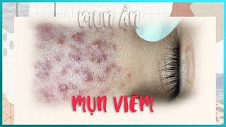 Big Cystic Acne Blackheads Extraction Blackheads amp Milia Whiteheads Removal Pimple Popping [upl. by Atews441]