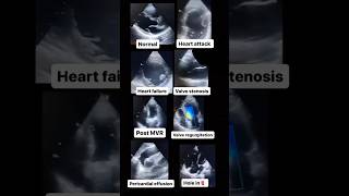 Echocardiogram NORMAL vs ABNORMAL radiology cardiology [upl. by Quartas]