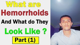 What are Hemorrhoids and What do they Look Like   Part 1 [upl. by Lunt979]