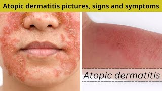 Atopic dermatitis pictures signs and symptoms  Nuse Healthy [upl. by Surdna]