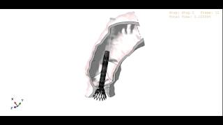 Medtronic CoreValve simulation [upl. by Nesmat867]