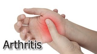 Ayurvedic Therapy for Arthritis Joint Pain Knee Pain By Dr Charak  Part 2 [upl. by Krawczyk]