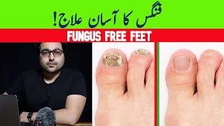 Dr ZeeGet Rid Of Toenail Fungus A complete guide [upl. by Anivla]