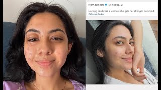 Reem Shaikh recovers from facial burns endured on set of Laughter Chefs Shares Inspirational Post [upl. by Eecats359]