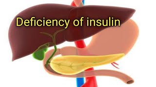 Insulin Deficiency  Diabetes Mellitus type 1 IDDM and type 2 NIDDM [upl. by Ynaffad511]