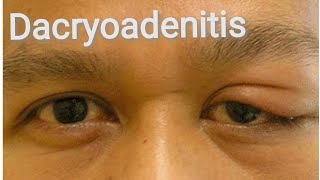 Lacrimal System  Dacryoadenitis  Watery eye Part 3 [upl. by Jaella]