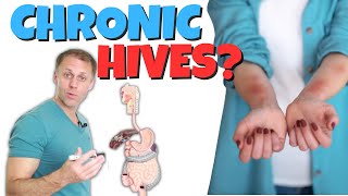 Why Do I Have Chronic Hives Urticaria [upl. by Chan]